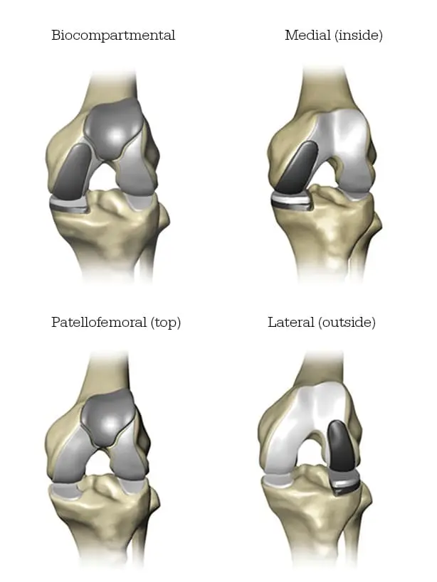 knee replacement